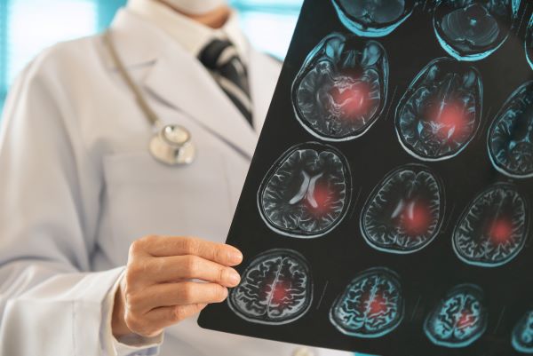 physician looking at stroke imaging