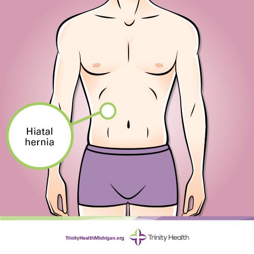 Hiatal hernia location graphic
