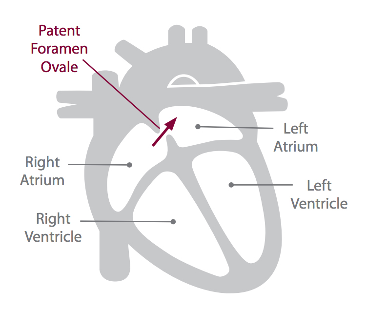 patent foramen ovale