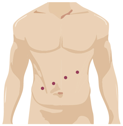 Robotic surgery incision for colorectal surgery